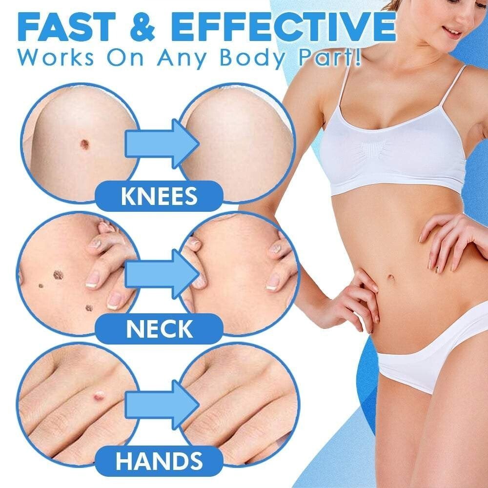 SMART Auto micro skin tag remover