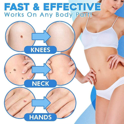 SMART Auto micro skin tag remover