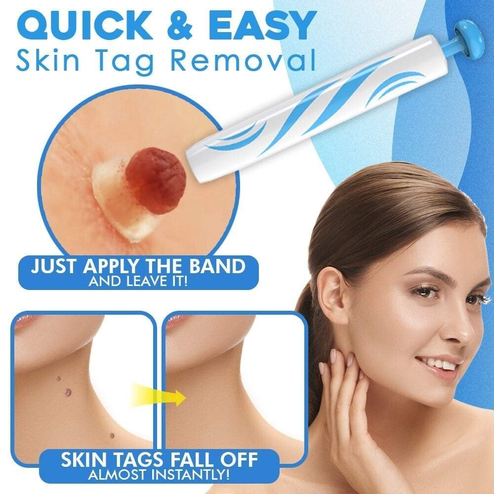 SMART Auto micro skin tag remover
